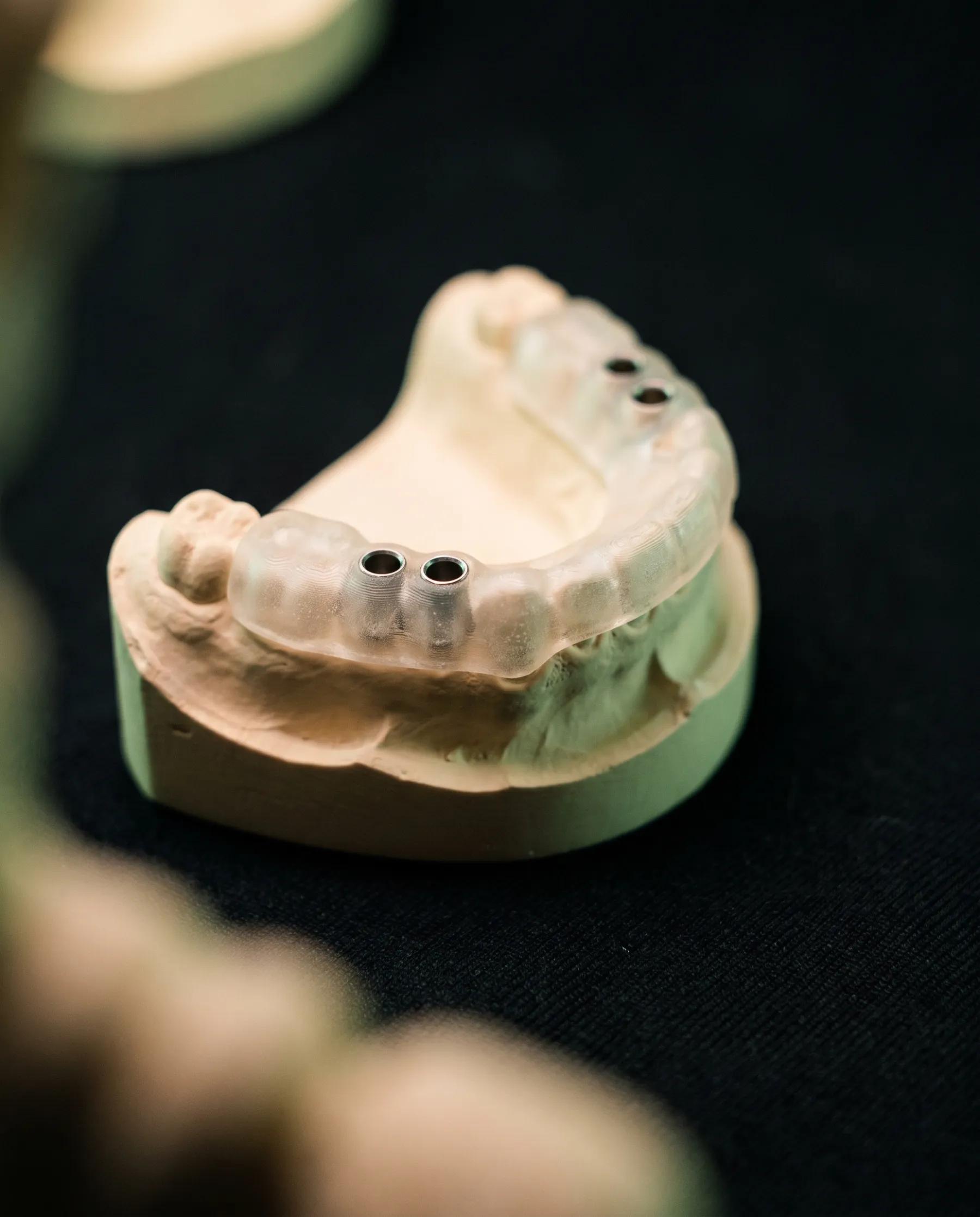 Guide chirurgical en résine transparente posé sur un modèle en plâtre, ses douilles métalliques marquant l'axe prévu pour les implants