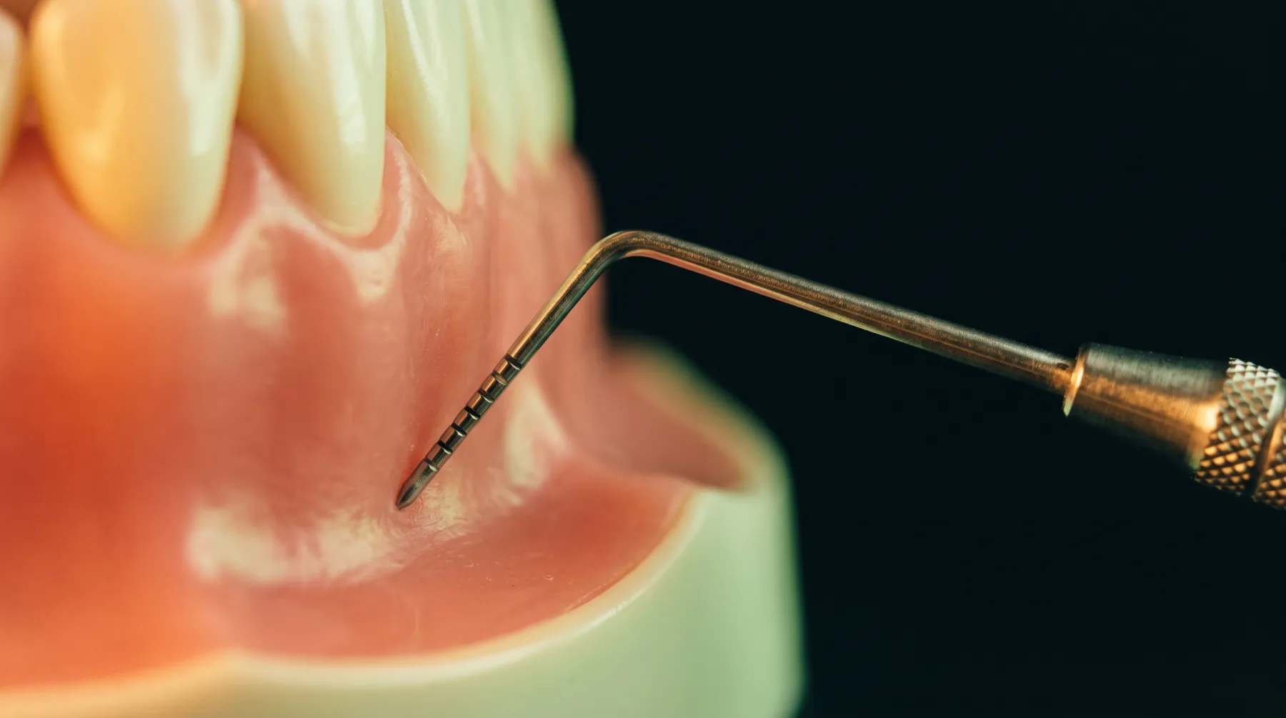 Sonde parodontale graduée placée au collet d'une dent, sur un modèle