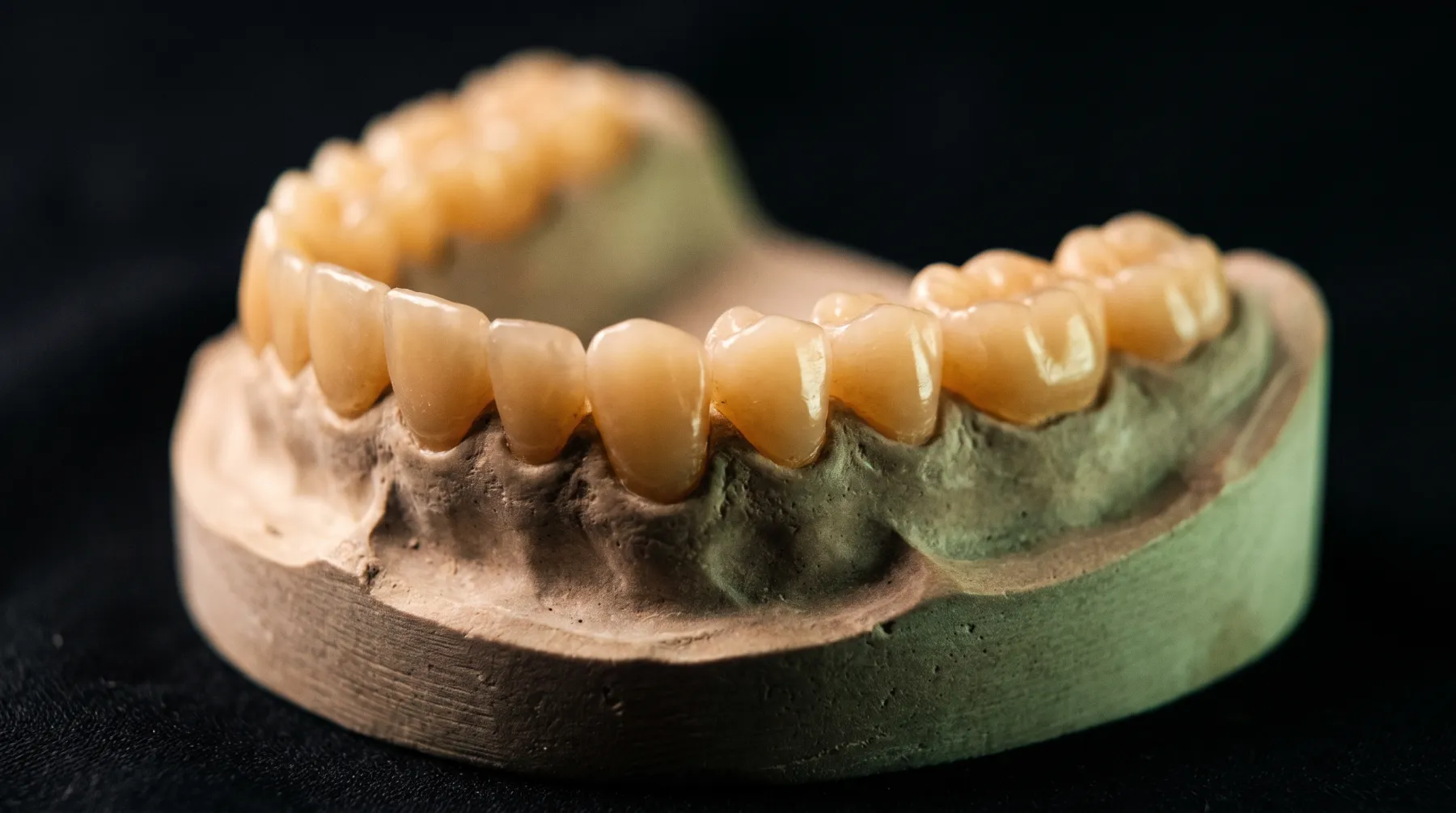 Maquette en cire modelée sur un modèle en plâtre, qui redonne aux dents usées leur hauteur et leur relief