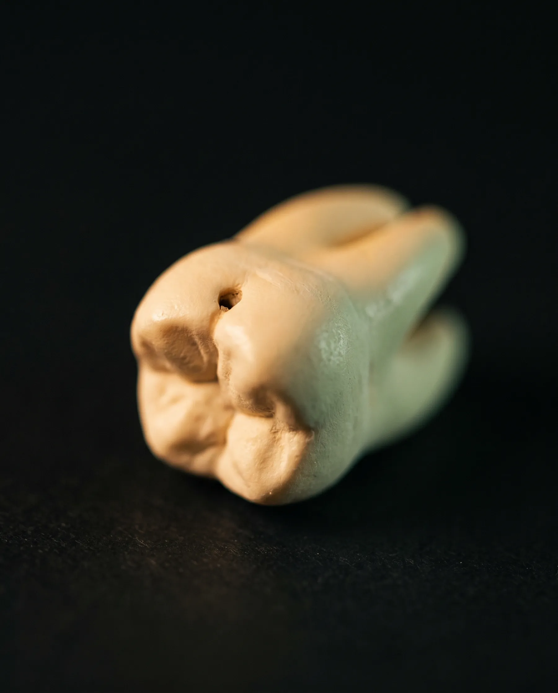 Molaire extraite posée sur un fond sombre, avec une cavité carieuse sombre creusée dans la face de mastication