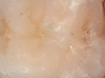 Après — vue de dessus d'une molaire