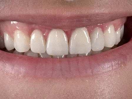 Après — gros plan du sourire, dents du haut
