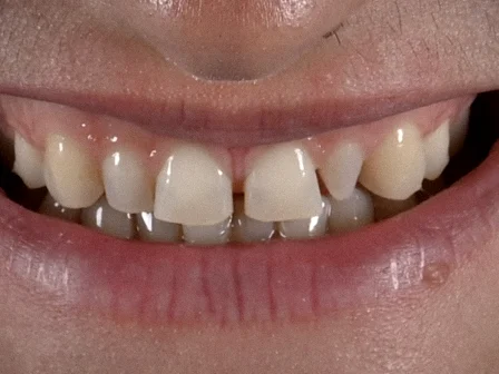 Avant — gros plan du sourire, dents du haut