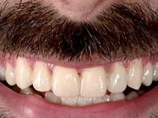Après — sourire de face, arcade supérieure