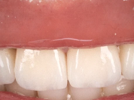 Après — gros plan de couronnes sur les dents du haut