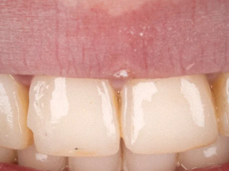 Avant — gros plan de couronnes sur les dents du haut