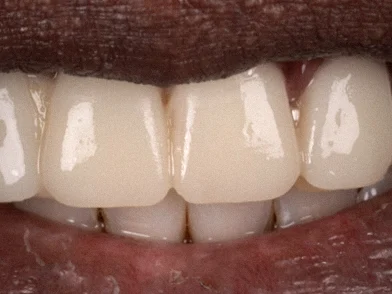 Après — sourire avec une dent absente sur le côté