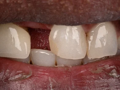 Avant — sourire avec une dent absente sur le côté